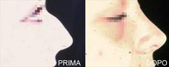 Rinoplastica prima/dopo - Caso 4