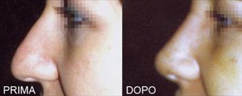 Rinoplastica prima/dopo - Caso 16