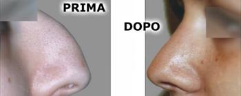 Rinoplastica prima/dopo - Caso 17