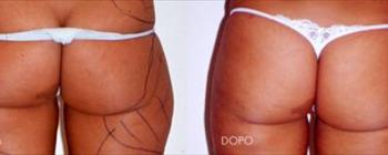 Liposuzione prima/dopo - Caso 1