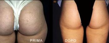 Liposuzione prima/dopo - Caso 2