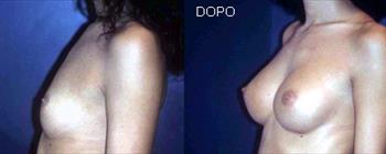 Mastoplastica additiva prima/dopo - Caso 4