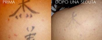 Rimozione tatuaggi prima/dopo - Caso 1
