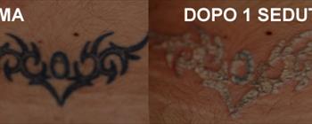 Rimozione tatuaggi prima/dopo - Caso 3