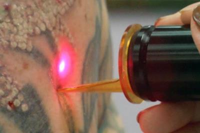 Rimozione tatuaggi
