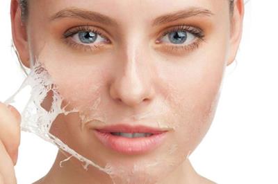 Peeling chimico