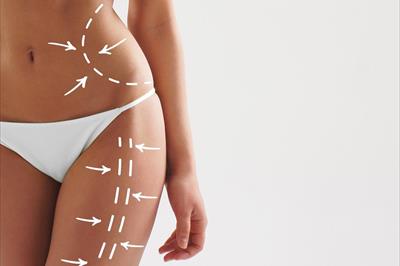 Liposuzione o Liposcultura