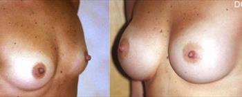 Mastoplastica additiva prima/dopo - Caso 7